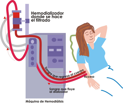 Proceso de hemodialisis